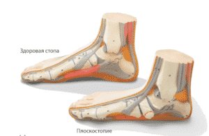 лечить плоскостопие в запорожье
