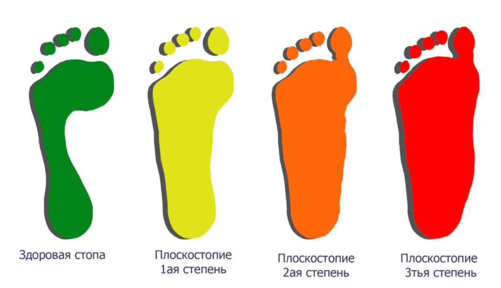 лечение плосткостопия в Запорожье