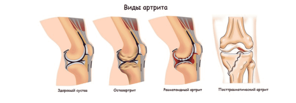 лечение артрита в Запорожье